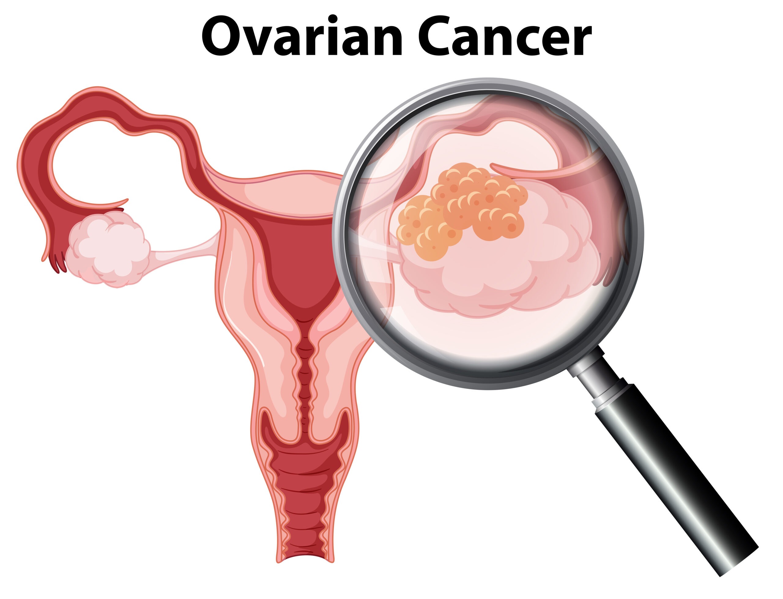 Ovarian Cancer on White Background