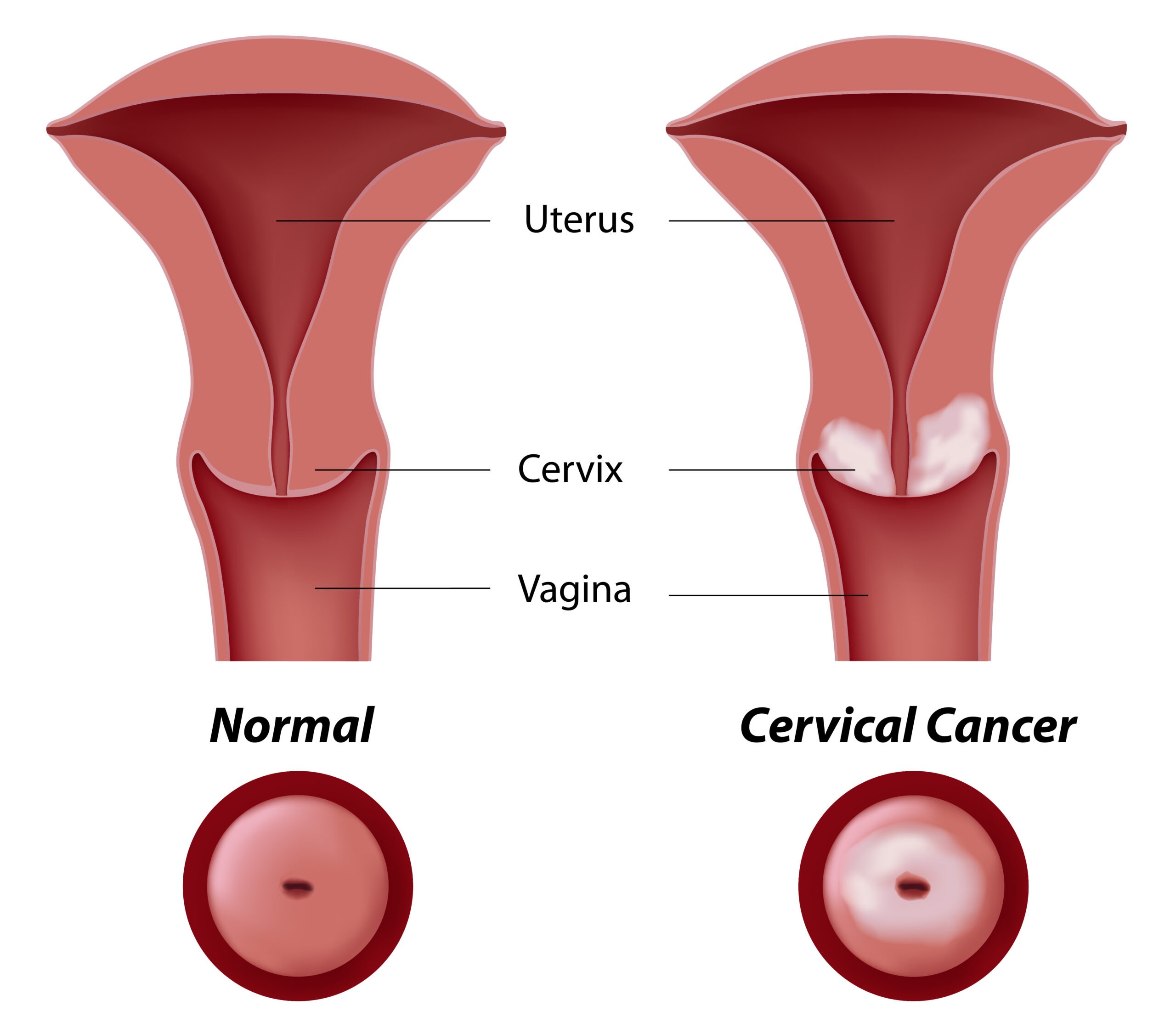 Cervical cancer